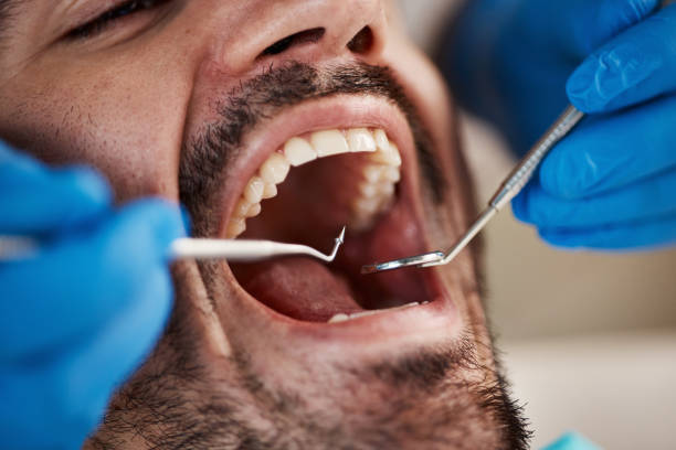 Best Emergency Wisdom Teeth Removal in Lovington, IL