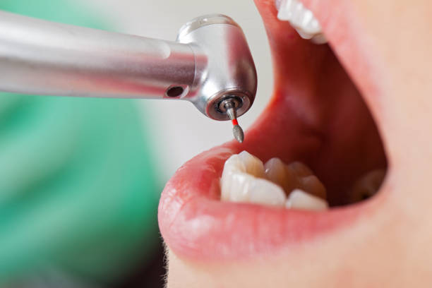Best Emergency Dental Care for Broken or Chipped Teeth in Lovington, IL